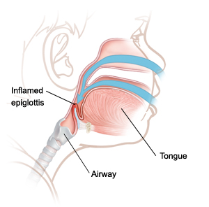 Side view of child's head showing throat anatomy with inflamed epiglottis.