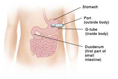 Front view of child's abdomen showing G-tube inserted through body wall into stomach.