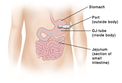 When Your Child Needs Tube Feeding Enteral Nutrition When Your Child Needs Tube Feeding Enteral Nutrition