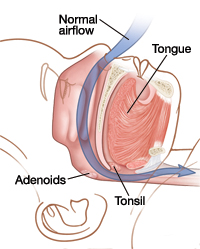 Outline of child's head showing tongue, adenoids, and tonsil. Arrow shows normal airflow going through nose, past adenoids and tonsils.