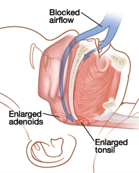 Outline of child's head showing enlarged adenoids and enlarged tonsil. Arrow shows enlarged adenoids and tonsils blocking airflow.