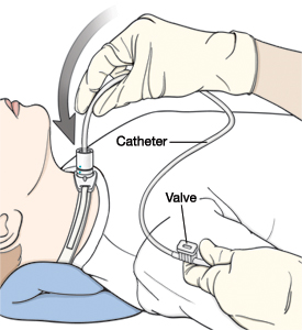 Child lying on back with pillow under neck. Gloved hand is inserting catheter into trach tube. Other hand is holding catheter near valve.