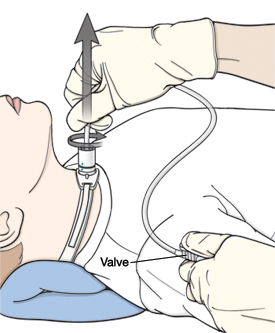 Child lying on back with pillow under neck. Gloved hand is twirling catheter and removing it from trach tube. Thumb of other hand is over valve.