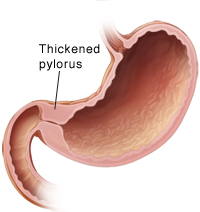 Cross section of stomach with thickened pylorus.