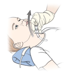 Child lying on back with pillow under neck. Gloved hand is removing old trach tube from child's neck.