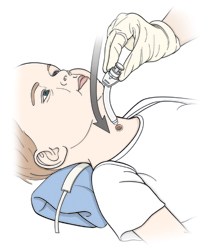 Child lying on back with pillow under neck. Gloved hand is inserting new trach tube into child's neck.