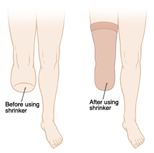 Amputated leg before and after using a shrinker.