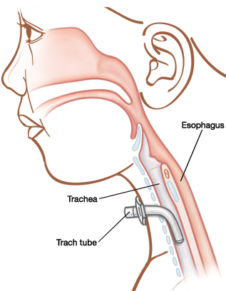 Outline of boy's head showing esophagus, trachea, and trach tube inserted in neck into trachea.