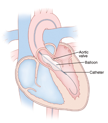 Front view cross section of heart showing atria on top and ventricles on bottom. Catheter is inserted through aorta into left ventricle. Balloon on catheter is inflated and widening aortic valve.