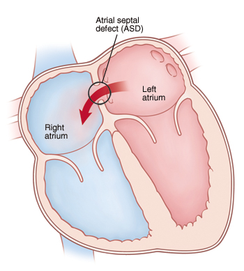 An ASD causes more blood than normal to move through the right side of the heart. Front view cross section of heart showing atrial septal defect (ASD) allowing blood to flow from left atrium to right atrium.