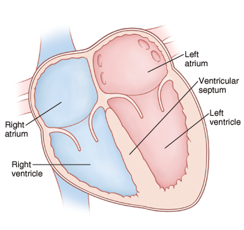 Front view cross section of heart showing atria on top and ventricles on bottom. Ventricular septum is between right ventricle and left ventricle.