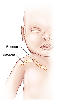 Outline of baby with fracture in clavicle.