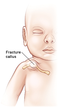 Outline of baby with fracture callus on clavicle.