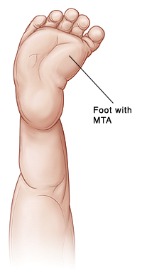 Outline of baby's leg showing front part of foot turned inward (MTA).