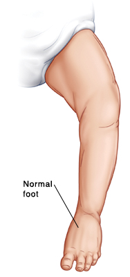 Outline of baby's leg showing normal foot.