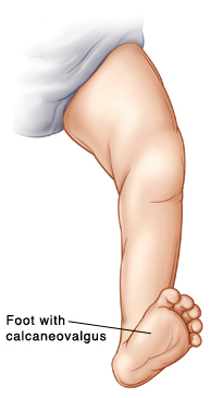 Outline of baby's leg showing foot pointing upward and outward (calcaneovalgus).