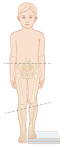 Outline of child with pelvis and leg bones visible. Left leg is shorter than right leg. Dotted line shows hips are level. Another dotted line shows knees at different heights.