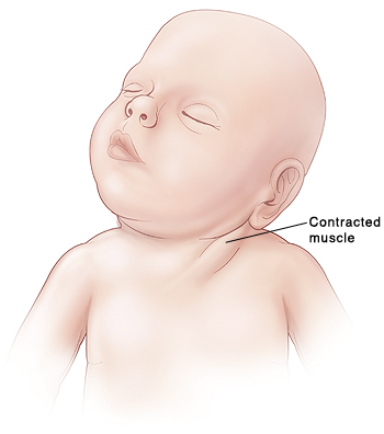Baby with head twisted to side and contracted muscle in neck.