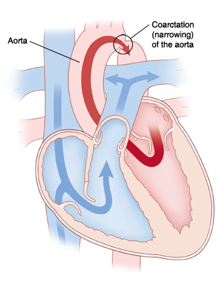 Front view cross section of heart showing coarctation (narrowing) of the aorta. Arrows show blood flowing from left side of heart through aorta and being partly blocked by narrowing. Arrows show blood flowing from right side of heart through pulmonary artery. 
