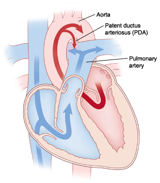 Front view cross section of heart showing patent ductus arteriosus connecting aorta and pulmonary artery. Arrows show blood flowing from left ventricle through aorta and some blood flowing through PDA to pulmonary artery.