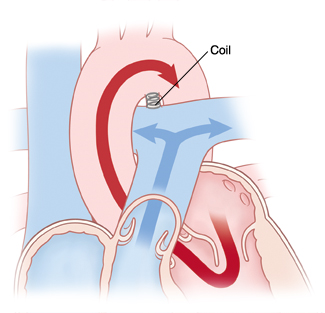 Closeup of patent ductus arteriosus showing coil closing it off.
