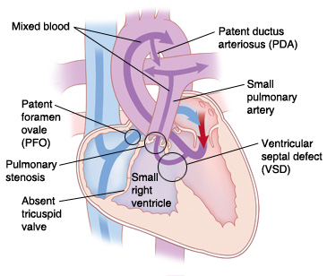 Front view cross section of heart showing tricuspid atresia and patent ductus arteriosus (PDA), small right ventricle, absent tricuspid valve, patent foramen ovale (PFO), pulmonary stenosis, and ventricular septal defect (VSD). Arrows show blood flowing from right atrium through PFO to left atrium, and mixed blood flowing from left ventricle to lungs and body.