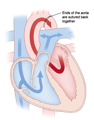 Image showing sutured ends of the aorta to restore blood flow back to normal in a child with COA.