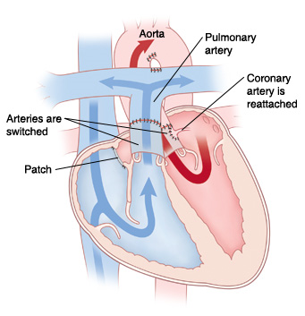 Front view cross section of heart showing repair for transposition of the great arteries. Aorta and pulmonary artery are switched. Patch is between atria. Coronary artery is reattached to aorta.