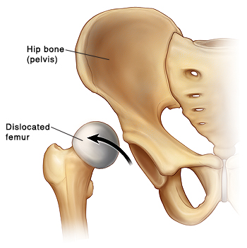 Front view of hip bone (pelvis) showing dislocated femur with head of femur coming out of socket.