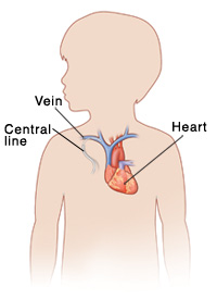 Outline of child with head turned to side showing central line inserted into vein near collarbone, and ending in heart.