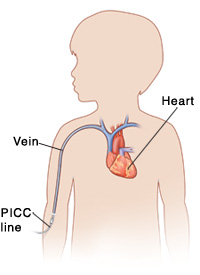 Outline of child with head turned to side showing PICC line inserted into vein near elbow, and ending in heart.