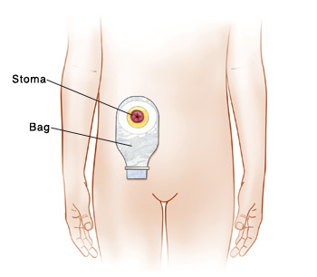 Outline of child's abdomen showing bag around stoma.
