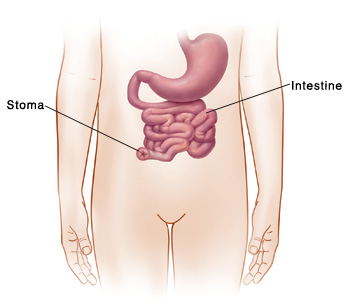 Outline of child's abdomen showing stomach and intestine. End of intestine goes through abdomen to make stoma.