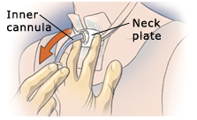 Drawing showing a person removing the inner cannula while holding the neck plate.