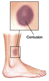 Side view of lower leg showing contusion on skin.