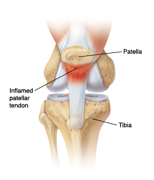 Front view of knee joint showing patella, tibia, and inflamed patellar tendon.
