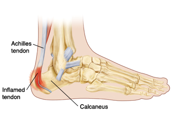Outline of side view of foot showing leg and foot bones and Achilles tendon connected to heel bone (calcaneus). Lower part of tendon is inflamed.