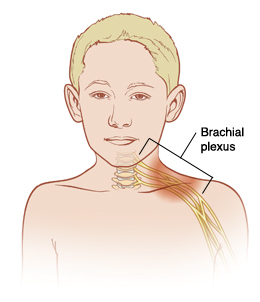 Outline of boy showing nerves coming from spine in neck and going down arm. Brachial plexus is group of nerves in neck and shoulder.