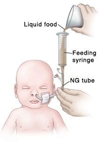 Outline of baby's head and chest showing NG tube in nose connected to feeding port and feeding syringe. Hand is holding NG tube steady while other hand pours liquid food into feeding syringe.