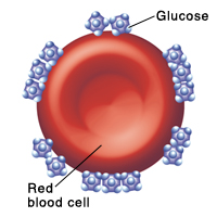 Red blood cell with many glucose molecules stuck to it.