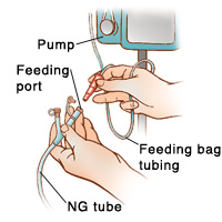 Closeup of hands disconnecting feeding port from NG tube. Feeding bag tubing is connected to pump.