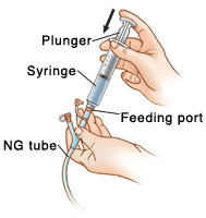 Closeup of hand holding NG tube with syringe inserted in feeding port. Other hand is pressing down plunger on syringe.