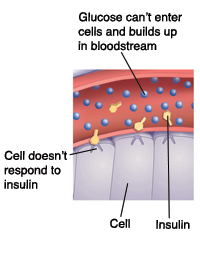 Closeup cross section of blood vessel near cells showing Type 2 diabetes. Cell doesn't respond to insulin. Glucose can't enter cells and builds up in bloodstream.