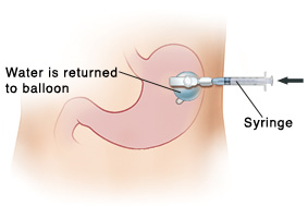 Closeup of abdomen with stomach visible inside. G-tube goes through skin with valve on outside of body and balloon inside stomach. Arrow shows plunger on syringe being pushed towards body to return water to balloon.