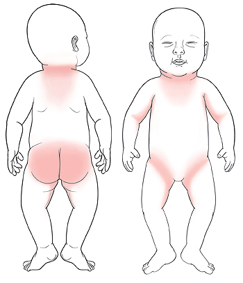 Outline of baby from back with shaded areas around neck and on buttocks and inner thighs. Outline of baby from front with shaded areas around neck, in armpits, and in groin.