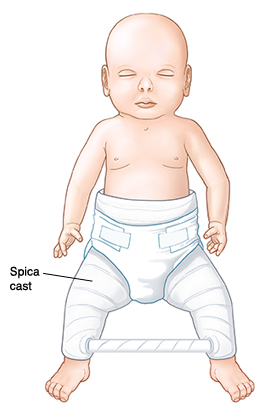 Baby with spica cast on lower body and legs. Bar connects cast at lower legs.