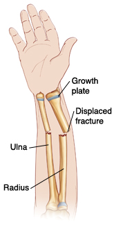 Palm view of hand and forearm showing radius and ulna. Displaced fractures go across radius and ulna. Ends of bones are not lined up. Growth plates are near wrist.