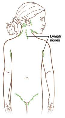 Outline of child showing lymph nodes in front of and behind ear, on side and back of neck, under chin, in armpits, and in groin.