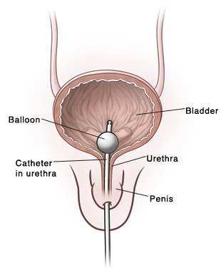 Front view of penis showing cross section of bladder and urethra. Catheter is inserted through urethra into bladder. Balloon in bladder holds catheter in place.