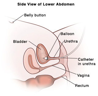 Cross section side view of female lower abdomen showing belly button, bladder, urethra, vagina, and rectum. Catheter is inserted through urethra into bladder. Balloon in bladder holds it in place.